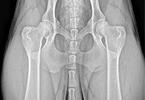 Radiograph of Normal Hips